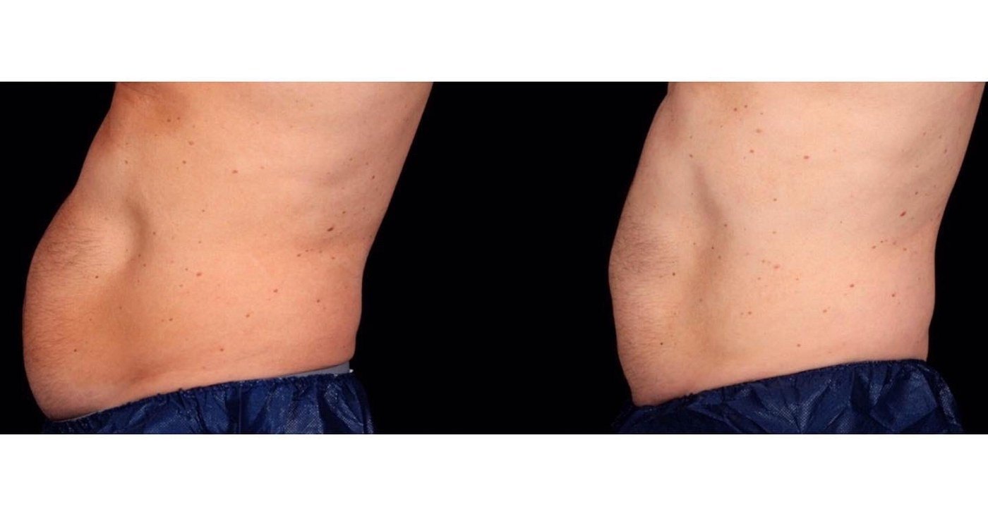 עיצוב גוף — before and after