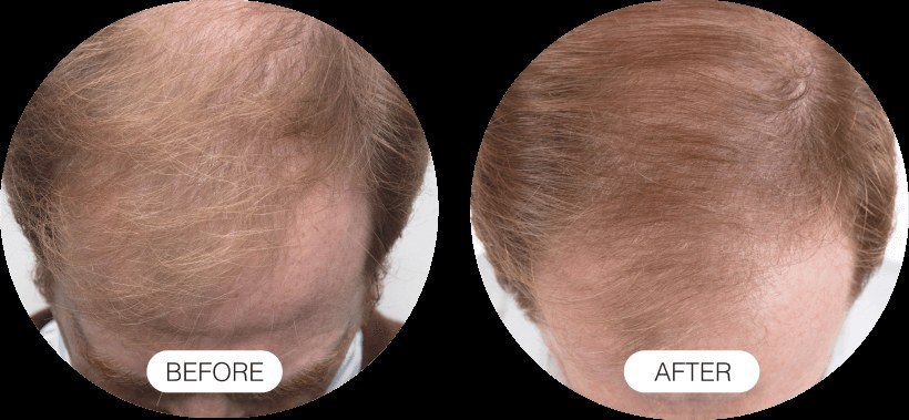 Hair Growth — before and after