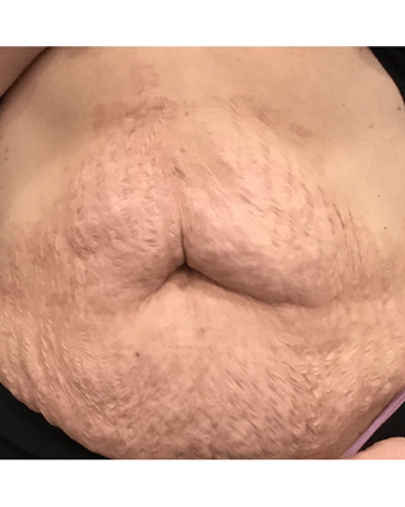 DeepRF — הידוק גוף — before