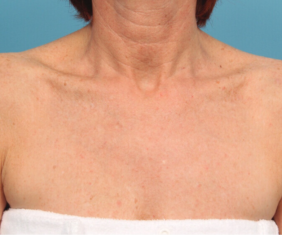 נזקי שמש ופיגמנטציה — after
