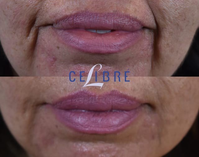 חידוש עור — before and after