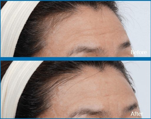 מיצוק עור — before and after