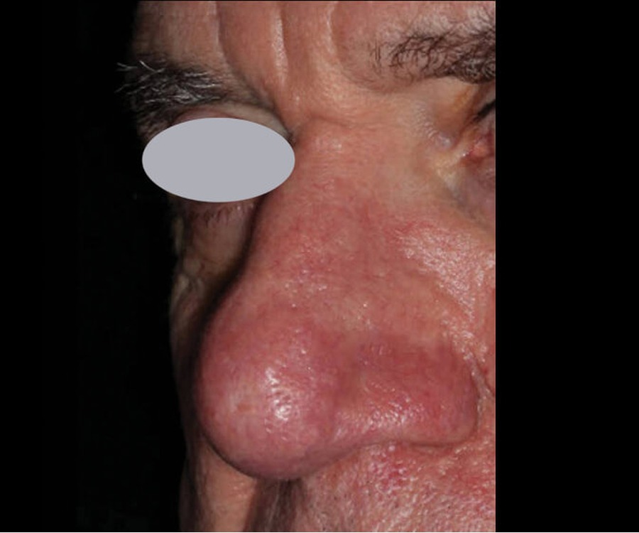 נגעים וסקולריים — after