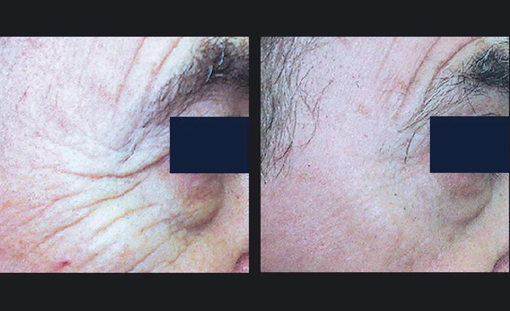 חידוש עור — before and after