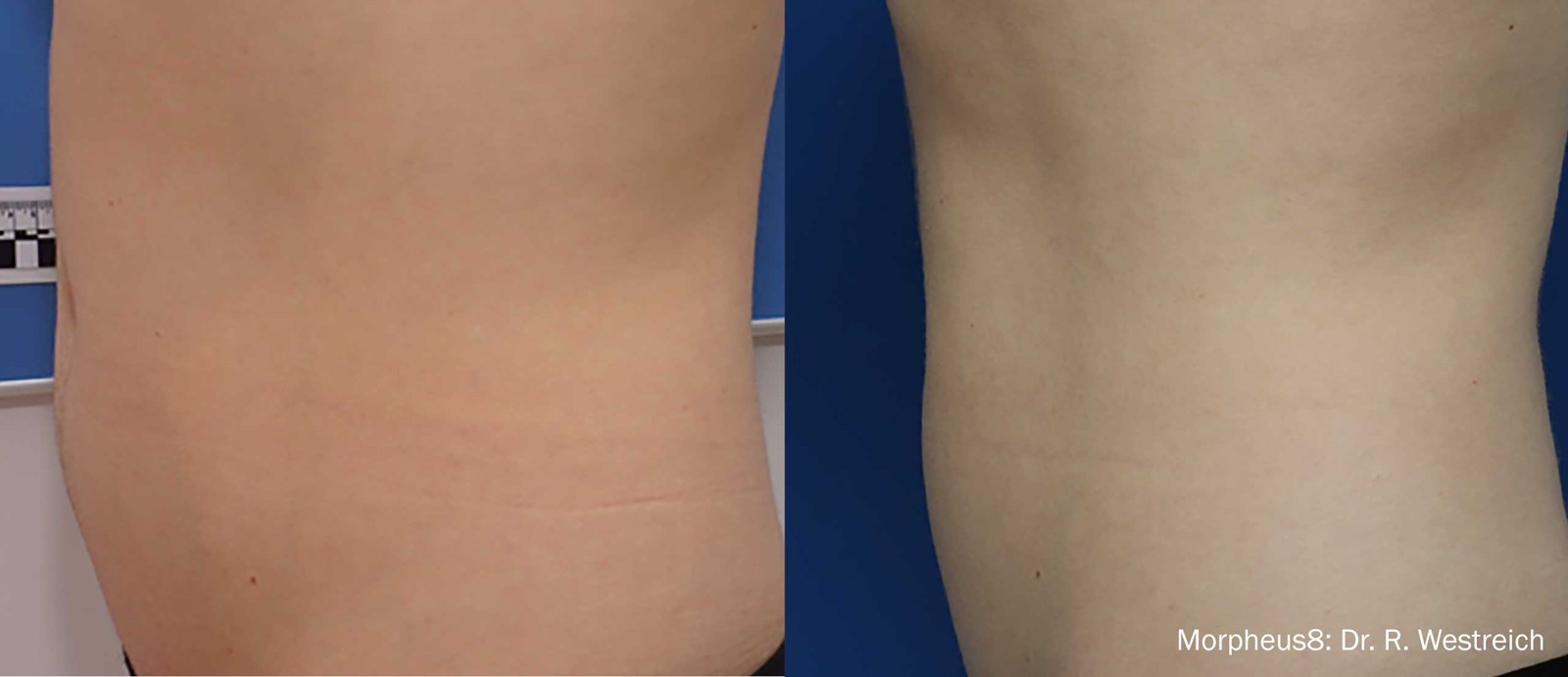 עיצוב תת-עורי של הבטן — before and after