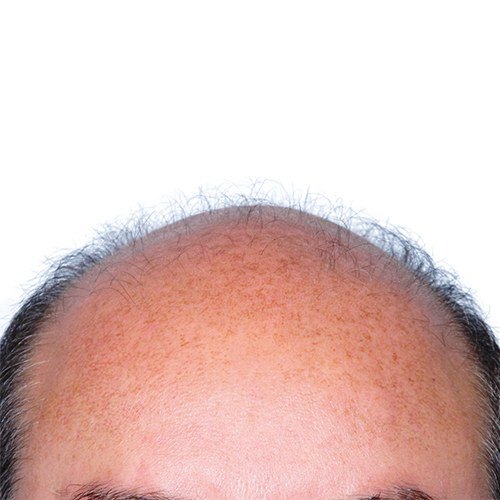 צמיחת שיער — before